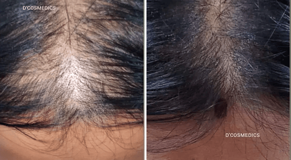Hairfall Treatment before/after