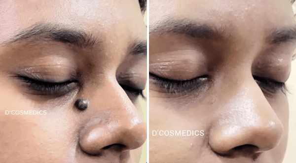 Mole Removal before/after