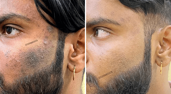Pigmentation Removal before/after
