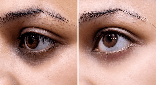 Dark Circle before/after