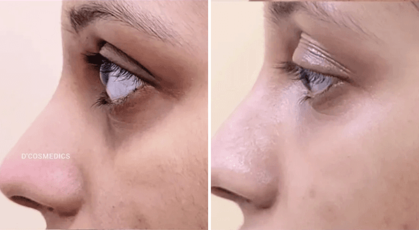 Dark Circle before/after