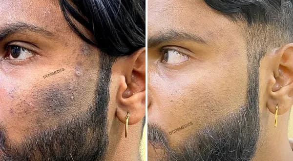 Pigmentation Removal