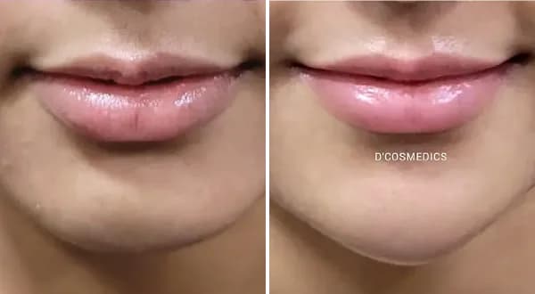 Chin Shaping