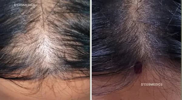 Hairfall Treatment