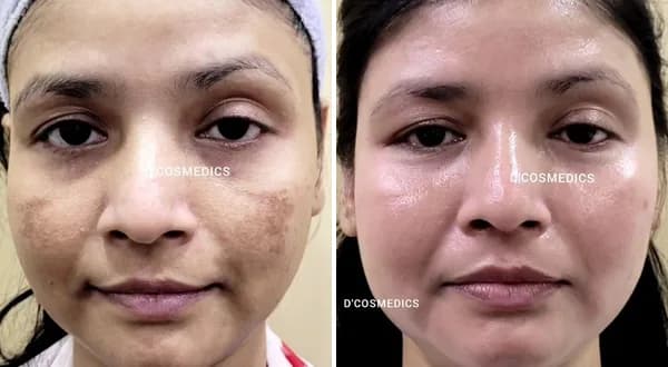 Pigmentation