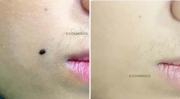 Mole Removal