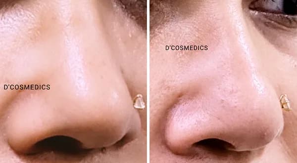 Nose Reshaping