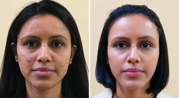 Acne Scar & Pigmentation
